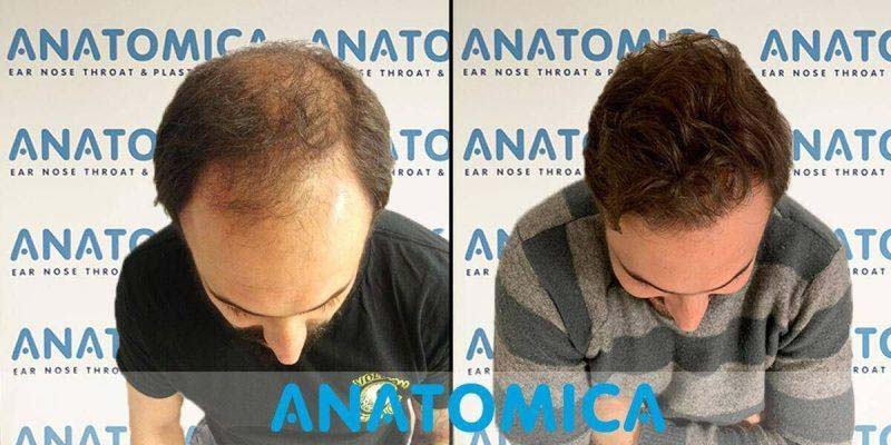 Antes y Despues Trasplante Capilar Logroño 2