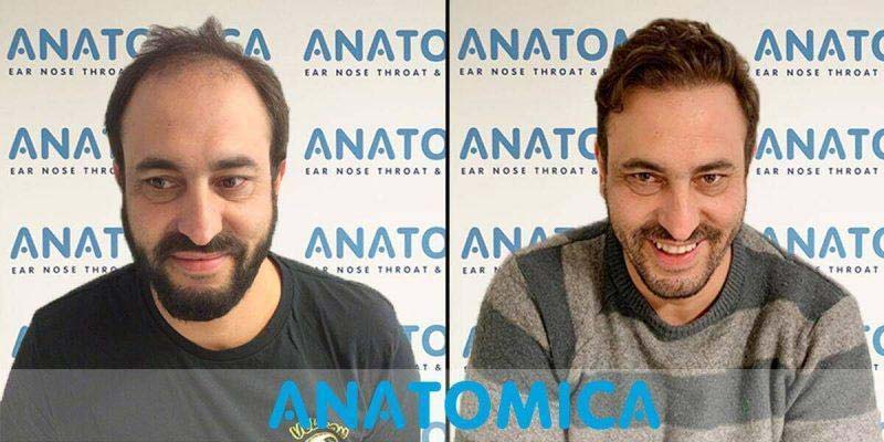 Antes y Despues Trasplante Capilar Lugo 1