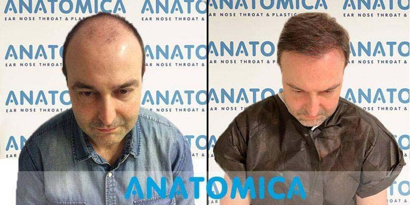 Antes y Despues Trasplante Capilar Lugo 4