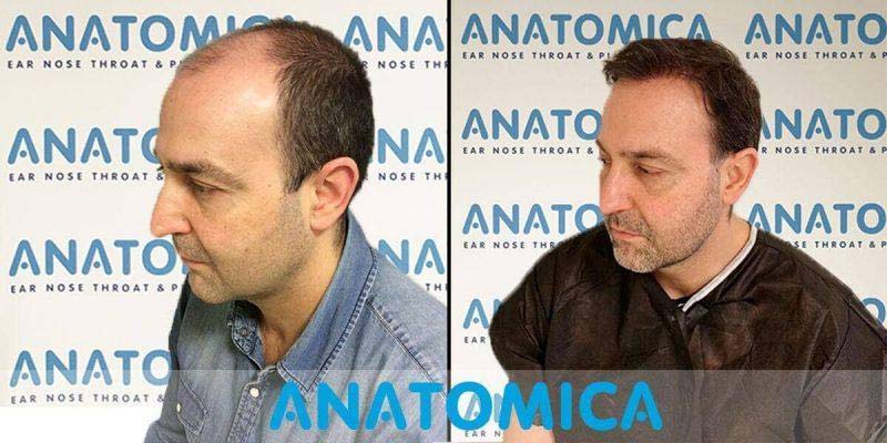 Antes y Despues Trasplante Capilar Lugo 5