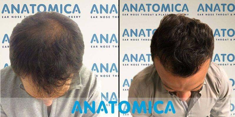 Antes y Despues Trasplante Capilar Lugo 6