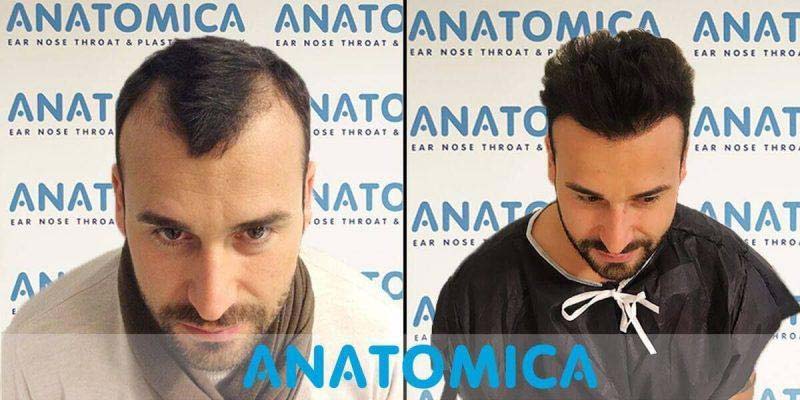 Antes y Despues Trasplante Capilar Tudela 3