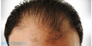mesoterapia