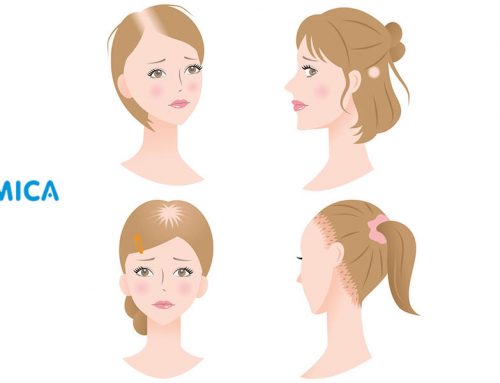 Preocupaciones Sobre la Tiña